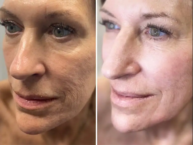 Trilift Treatment Before and after by Sorelle Aesthetics in Orefield, PA