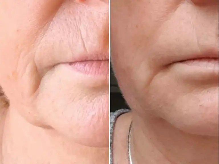 Trilift for smile lines Treatment Before and after by Sorelle Aesthetics in Orefield, PA