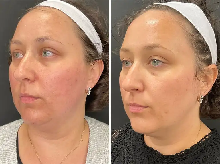 Trilift Facial Treatment Before and after by Sorelle Aesthetics in Orefield, PA