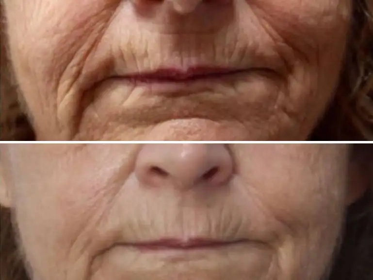 Trilift Facial Wrinkle Treatment Before and after by Sorelle Aesthetics in Orefield, PA