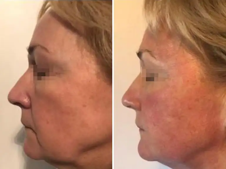 Non-Surgical Facelift Treatment Before and after by Sorelle Aesthetics in Orefield, PA