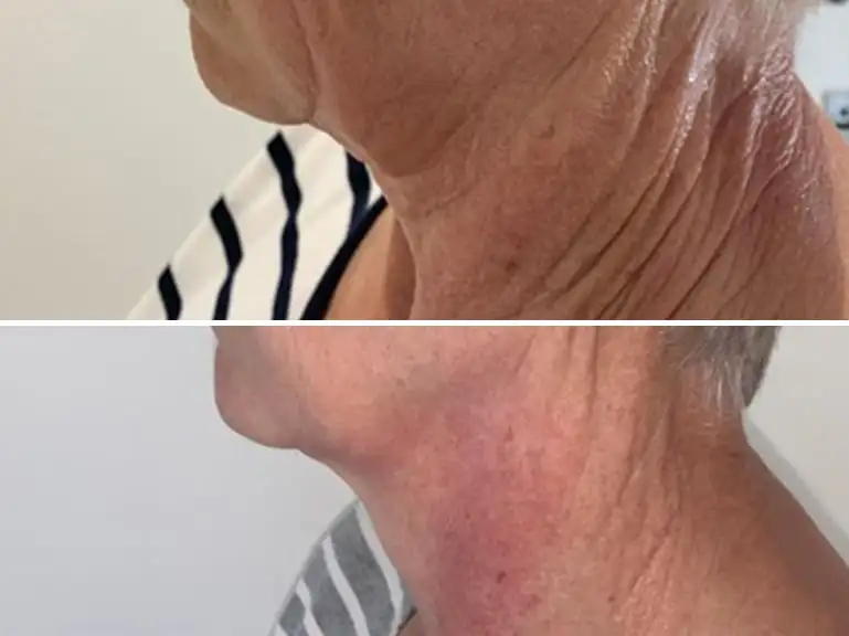 Trilift Neck Tightening Treatment Before and after by Sorelle Aesthetics in Orefield, PA