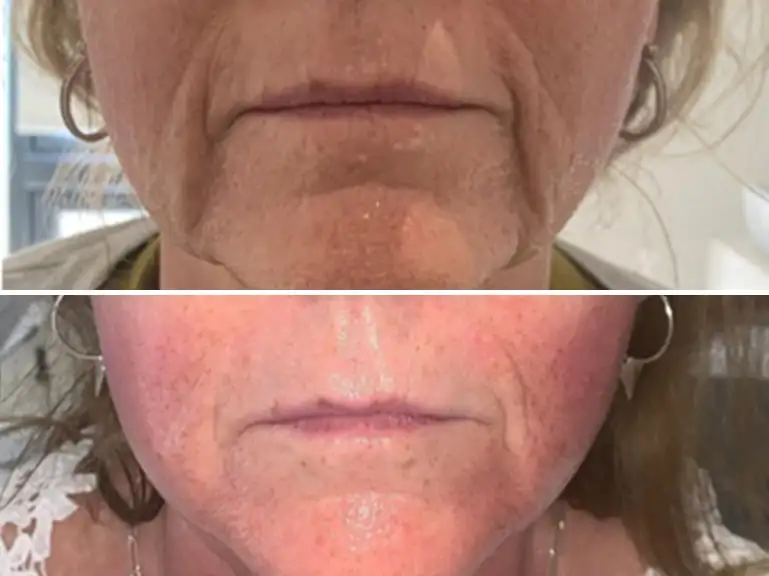 Non-Surgical Lip Filler Treatment by Sorelle Aesthetics in Orefield, PA