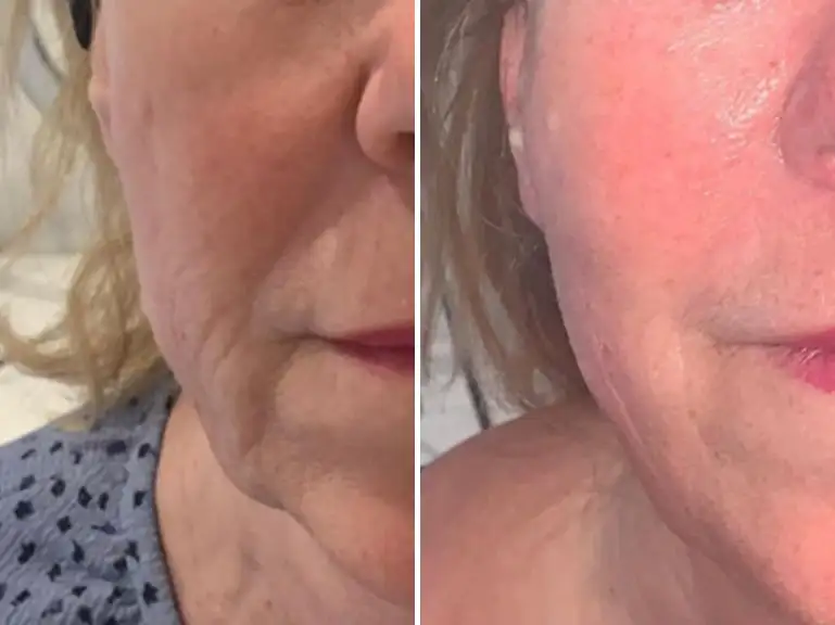 Non-Surgical Facelift Treatment by Sorelle Aesthetics in Orefield, PA