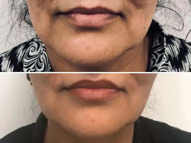 Trilift Lip Filler Before and After Images by Sorelle Aesthetics in Orefield, PA